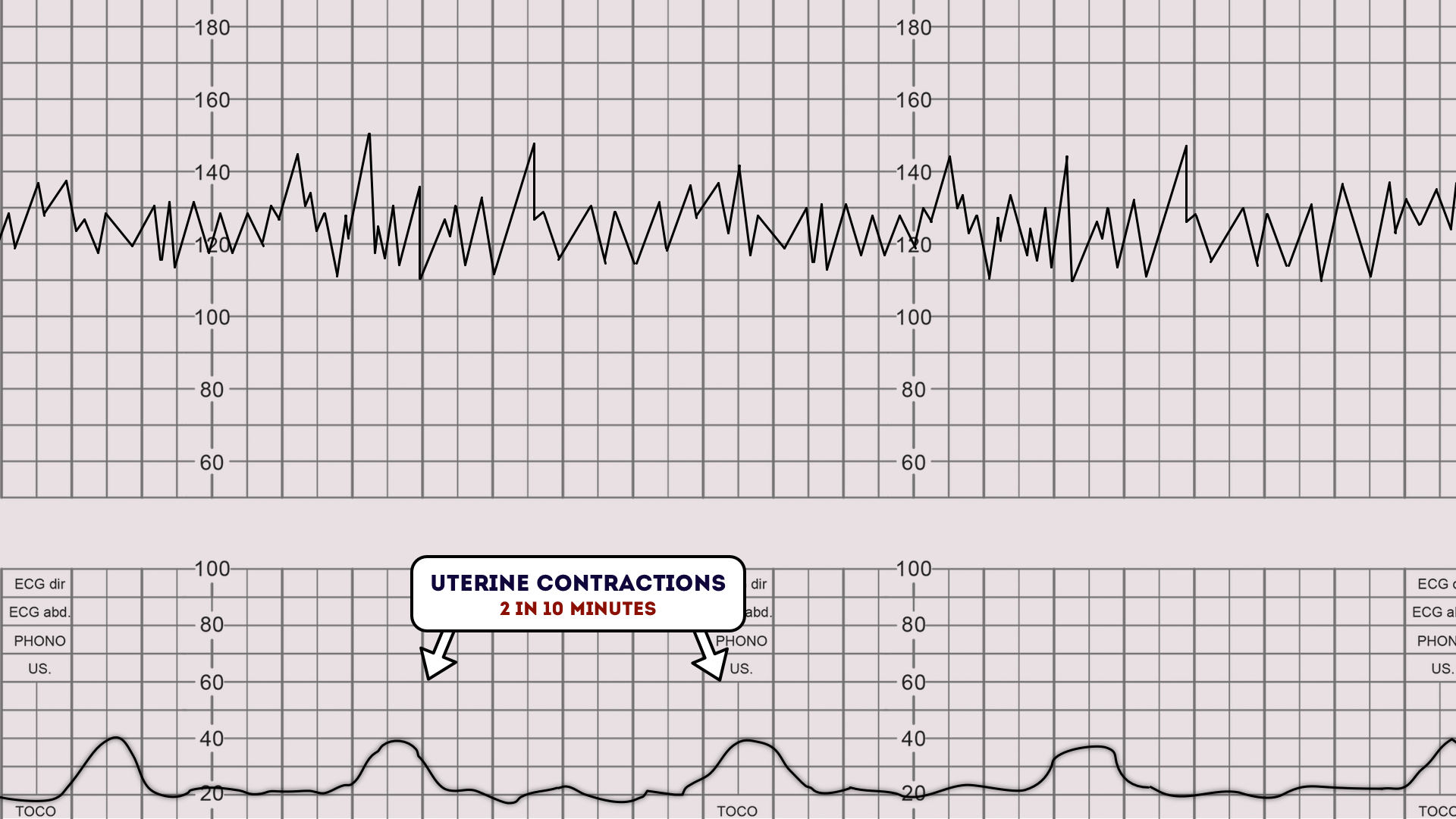 how-to-read-contractions-on-a-fetal-monitor
