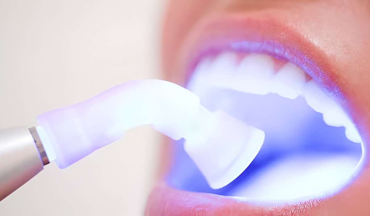 Oral Care Insights: Guidelines For The Duration Of Blue Light Teeth Treatment