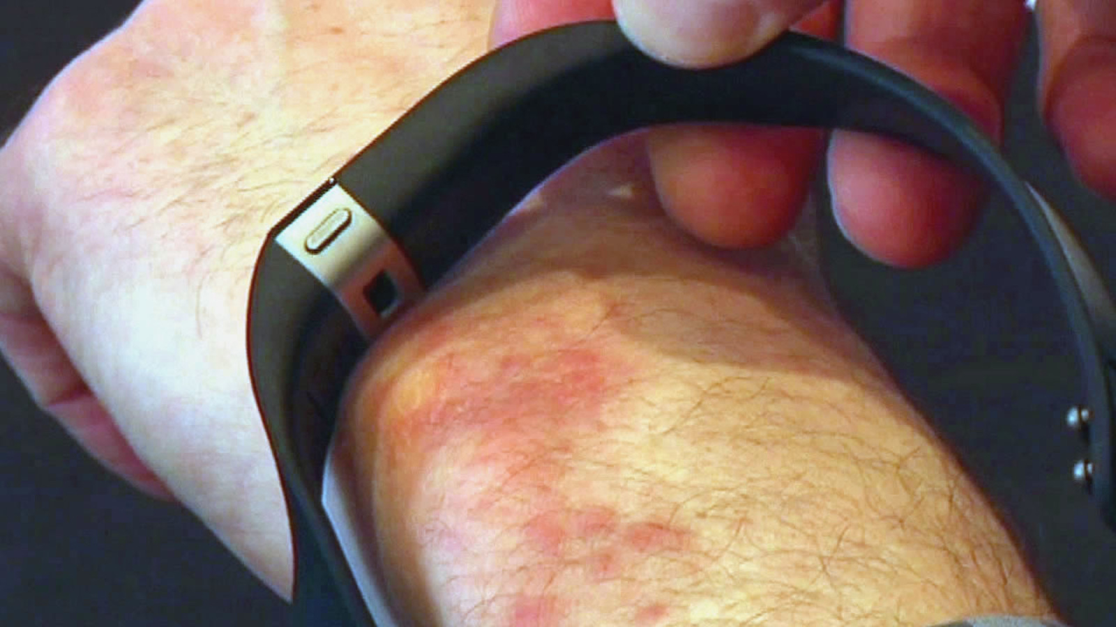 Rash Recognition: Understanding Why Your Fitbit Might Cause A Rash